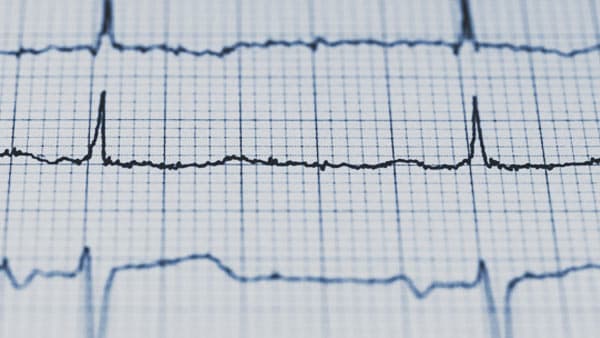 EKG health check
